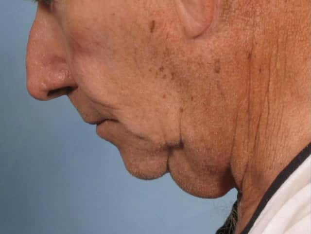 Neck Lift Before & After Case 187 before