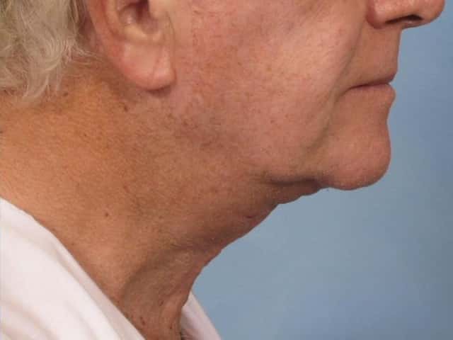 Neck Lift Before & After Case 187 after