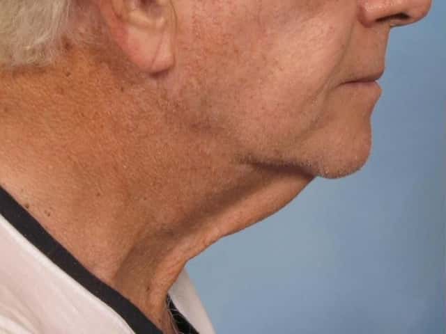 Neck Lift Before & After Case 187 before