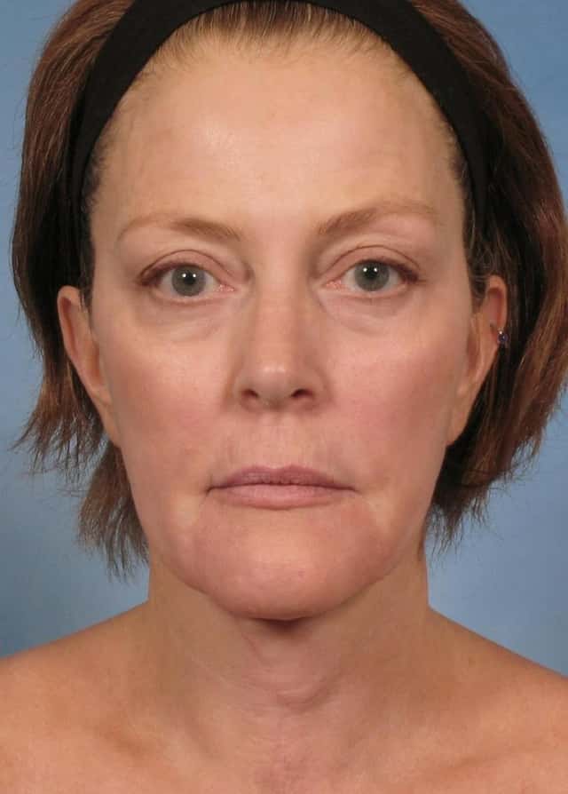 Neck Lift Before & After Case 188 after