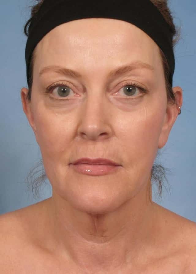 Neck Lift Before & After Case 188 before
