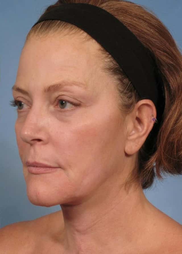 Neck Lift Before & After Case 188 after