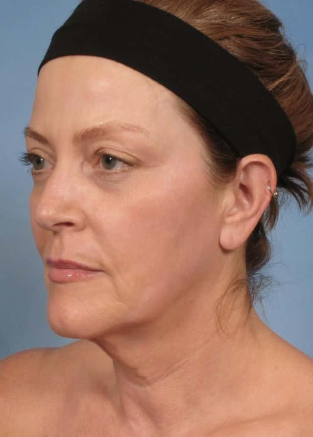 Neck Lift Before & After Case 188 before