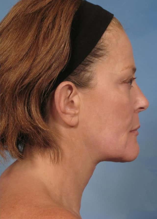 Neck Lift Before & After Case 188 after