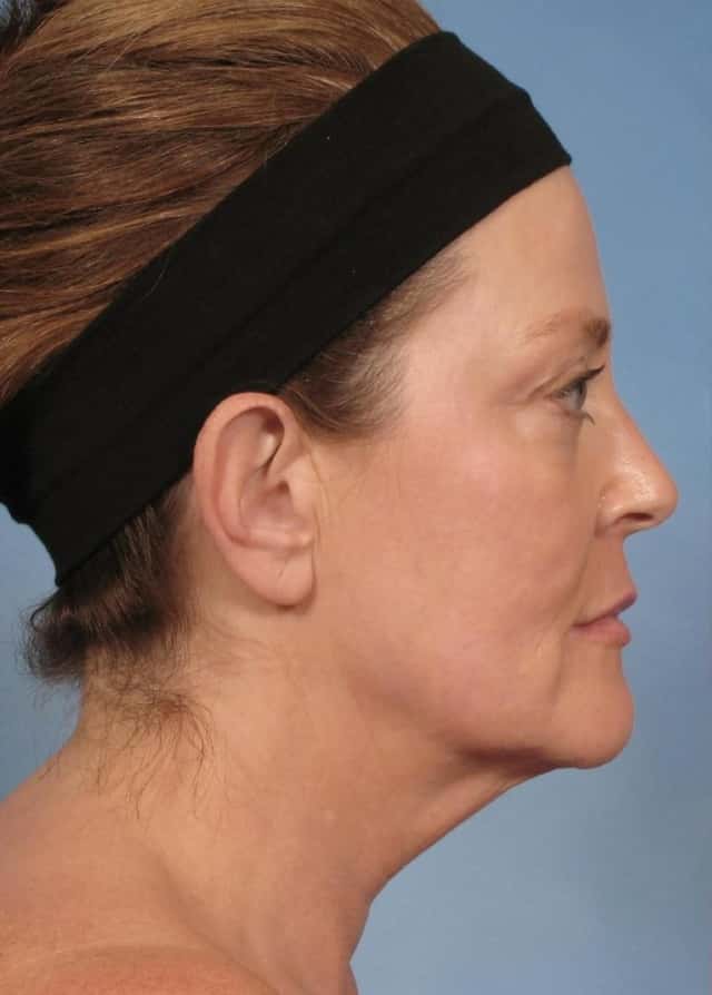 Neck Lift Before & After Case 188 before