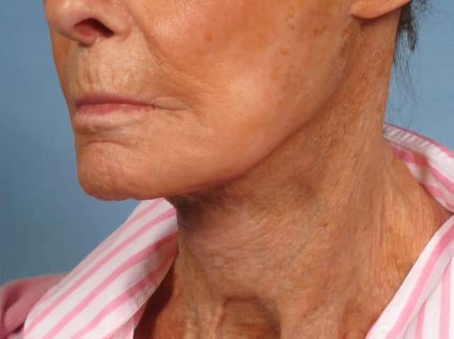 Neck Lift Before & After Case 189 after