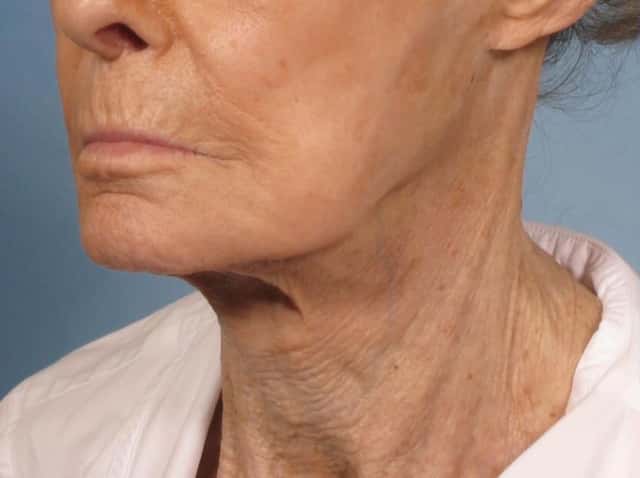 Neck Lift Before & After Case 189 before