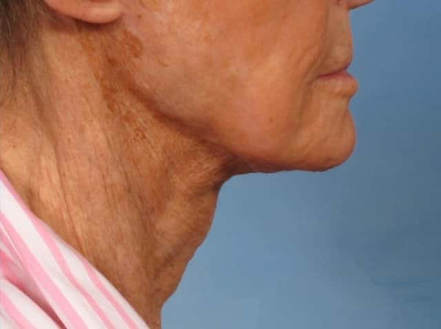 Neck Lift Before & After Case 189 after