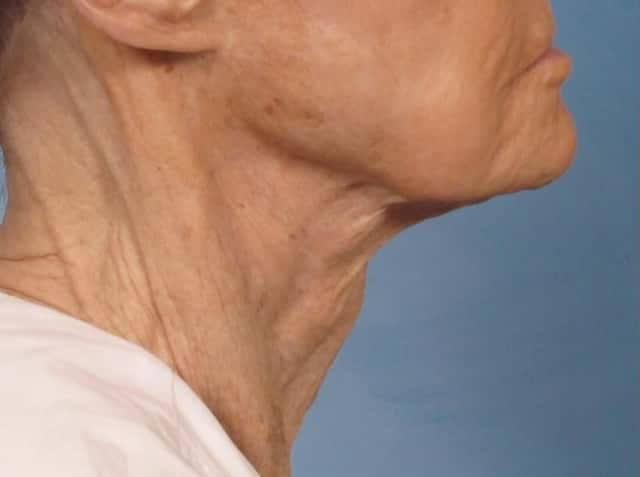 Neck Lift Before & After Case 189 before