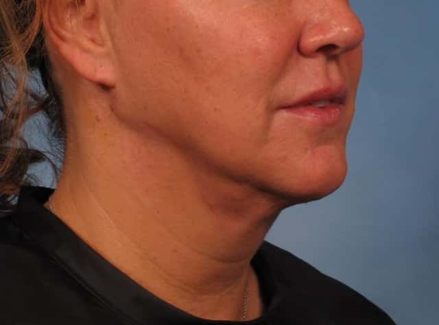 Neck Lift Before & After Case 276 after