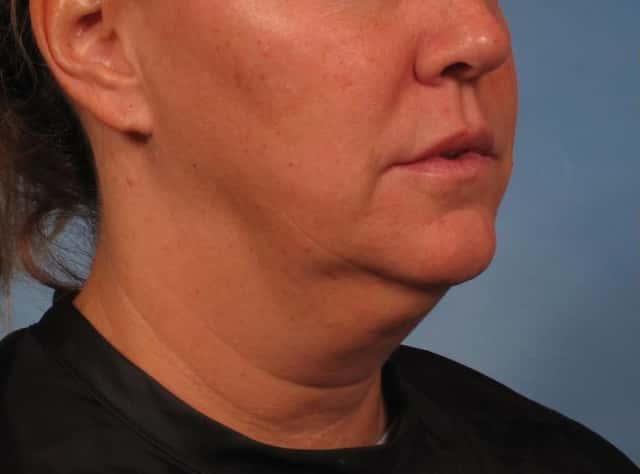 Neck Lift Before & After Case 276 before