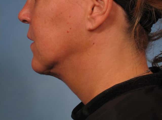 Neck Lift Before & After Case 276 after