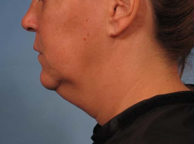 Neck Lift Before & After Case 276 before