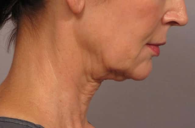 Neck Lift Before & After Case 301 before