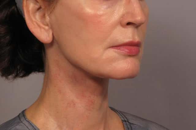 Neck Lift Before & After Case 301 after
