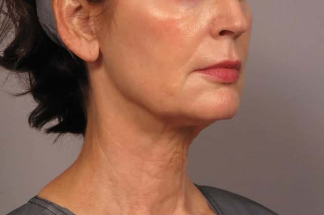 Neck Lift Before & After Case 301 before