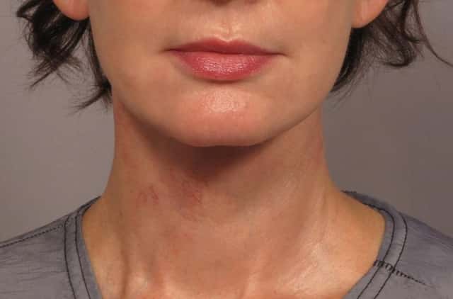 Neck Lift Before & After Case 301 after