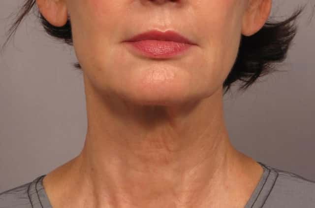 Neck Lift Before & After Case 301 before