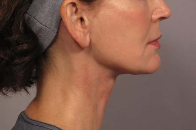 Neck Lift Before & After Case 301 after