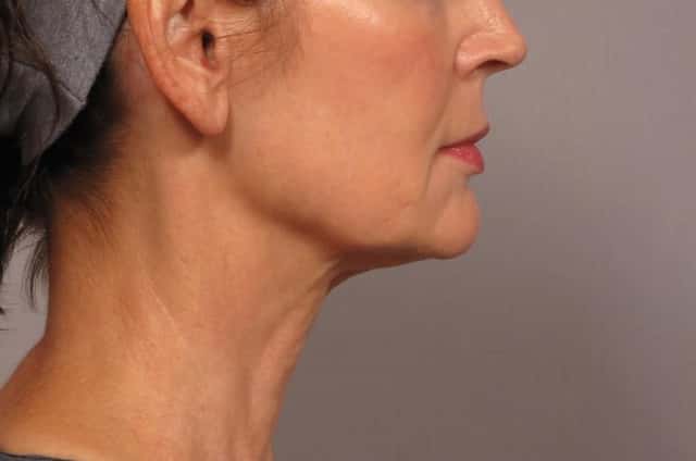 Neck Lift Before & After Case 301 before