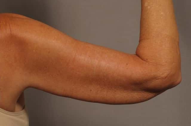 Back of right arm before liposuction and Renuvion, 3 weeks Post-op