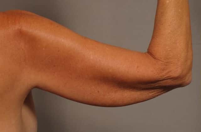 Back of right arm before liposuction and Renuvion, pre-op