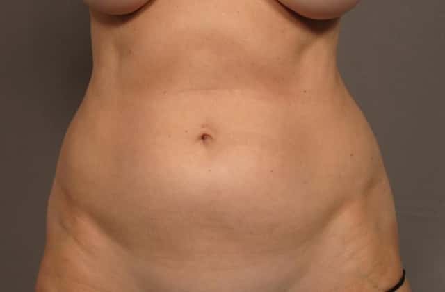 Frontal View of 59 year old Woman Before Renuvion and Liposuction to the Tummy