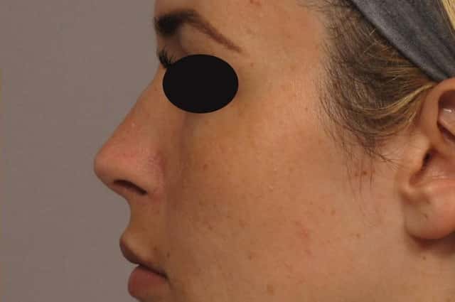 1 Year Post-op Left Side View of Rhinoplasty in Naples Florida by Dr. Kent Hasen