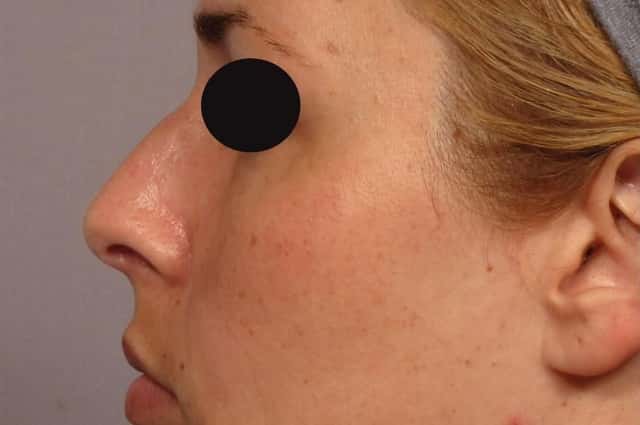 Pre-op Left Side View of Rhinoplasty in Naples Florida by Dr. Kent Hasen