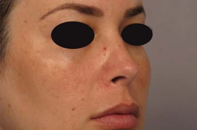 1 Year Post-op Right Oblique View of Rhinoplasty in Naples Florida by Dr. Kent Hasen