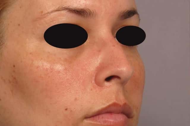 Pre-op Right Oblique View of Rhinoplasty in Naples Florida by Dr. Kent Hasen