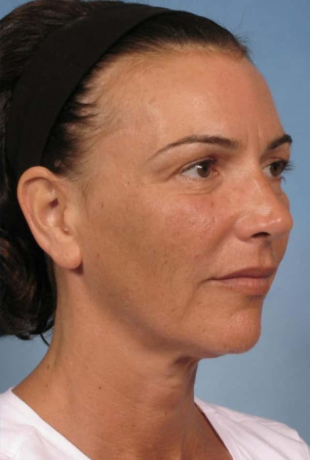Sculptra® Before & After Case 126 after