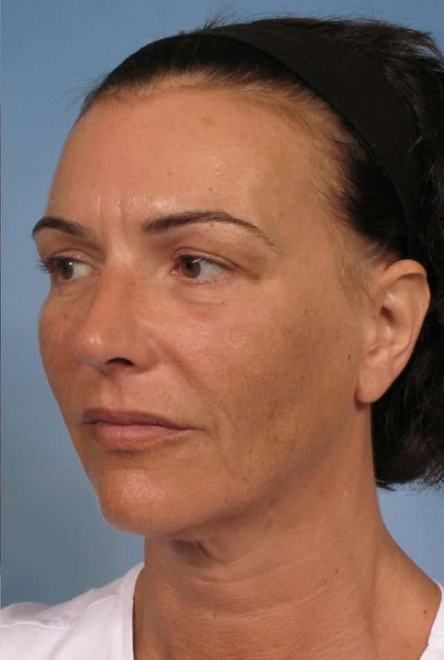 Sculptra® Before & After Case 126 after
