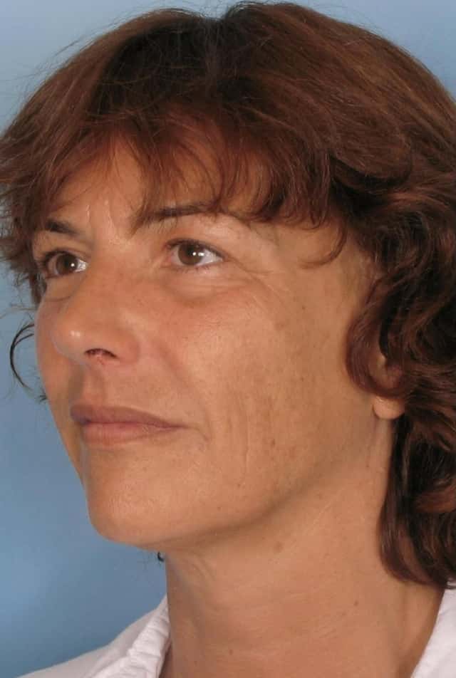 Sculptra® Before & After Case 126 before