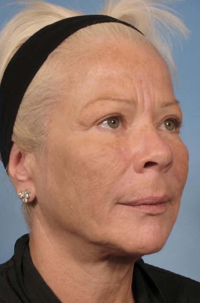 Sculptra® Before & After Case 84 after