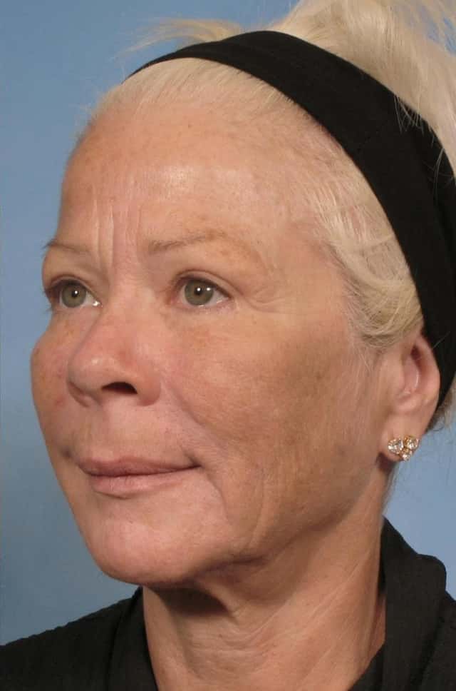 Sculptra® Before & After Case 84 after