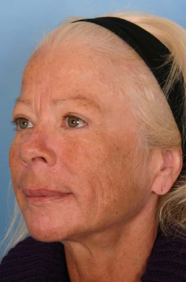 Sculptra® Before & After Case 84 before