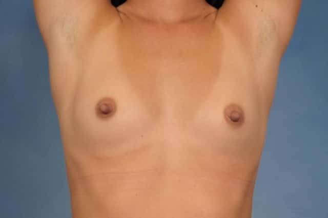 Silicone Breast Implants Before & After Case 105 before