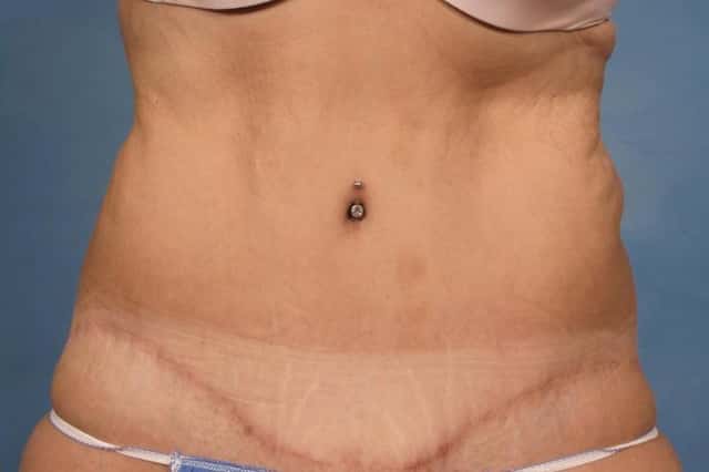 Tummy Tuck Before & After Case 112 after