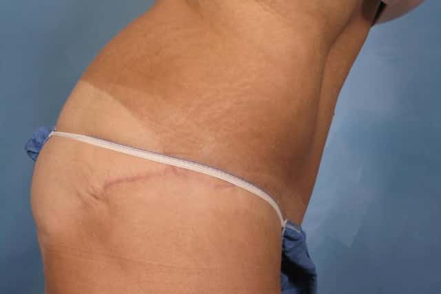 Tummy Tuck Before & After Case 112 after