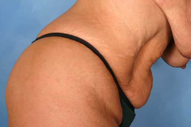 Tummy Tuck Before & After Case 112 before