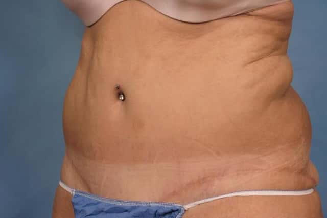Tummy Tuck Before & After Case 112 after