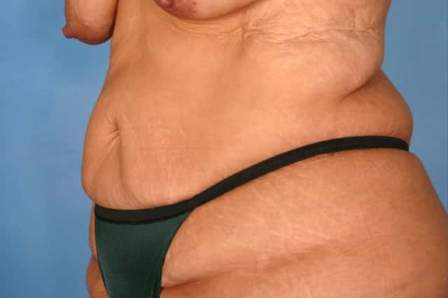Tummy Tuck Before & After Case 112 before