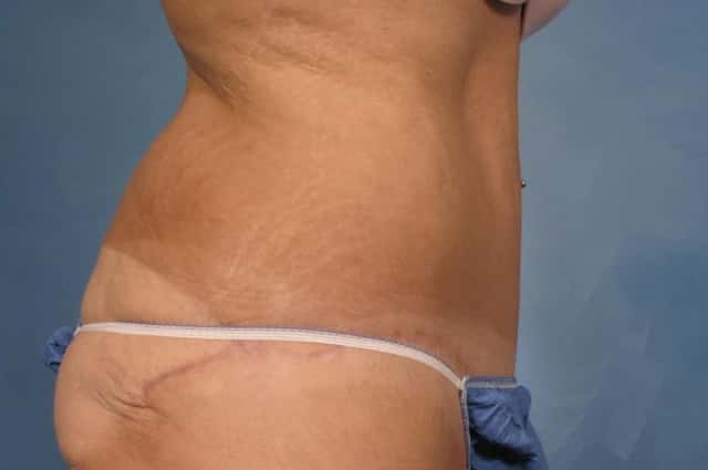 Tummy Tuck Before & After Case 112 after