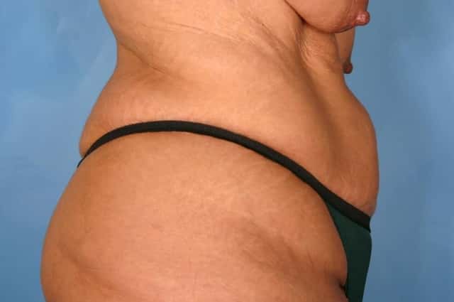 Tummy Tuck Before & After Case 112 before