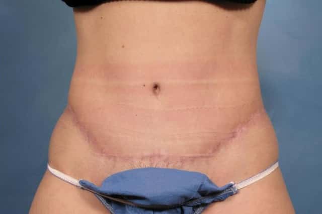 Tummy Tuck Before & After Case 113 after