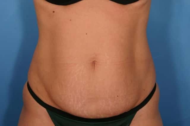 Tummy Tuck Before & After Case 113 before