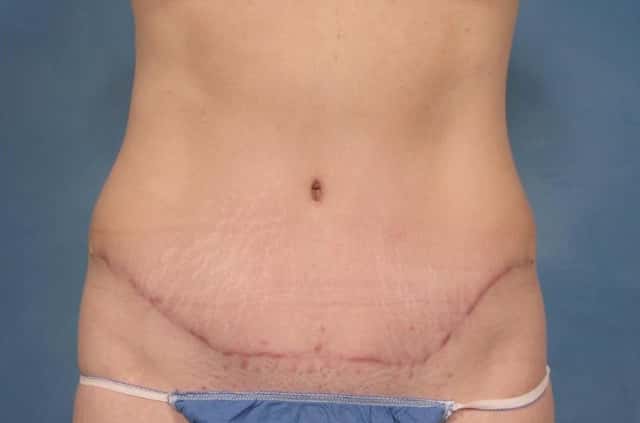 Tummy Tuck Before & After Case 114 after