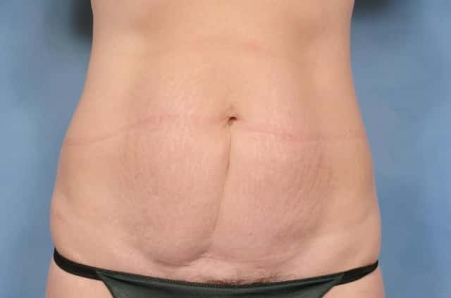 Tummy Tuck Before & After Case 114 before