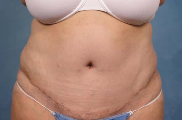Tummy Tuck Before & After Case 115 after